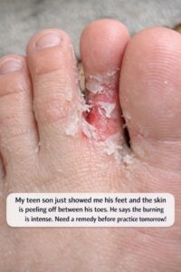 My teen son just showed me his feet and the skin is peeling off between his toes. He says the burning is intense. Need a remedy before practice tomorrow!