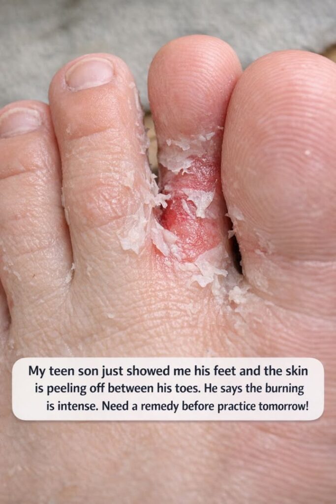 My teen son just showed me his feet and the skin is peeling off between his toes. He says the burning is intense. Need a remedy before practice tomorrow!