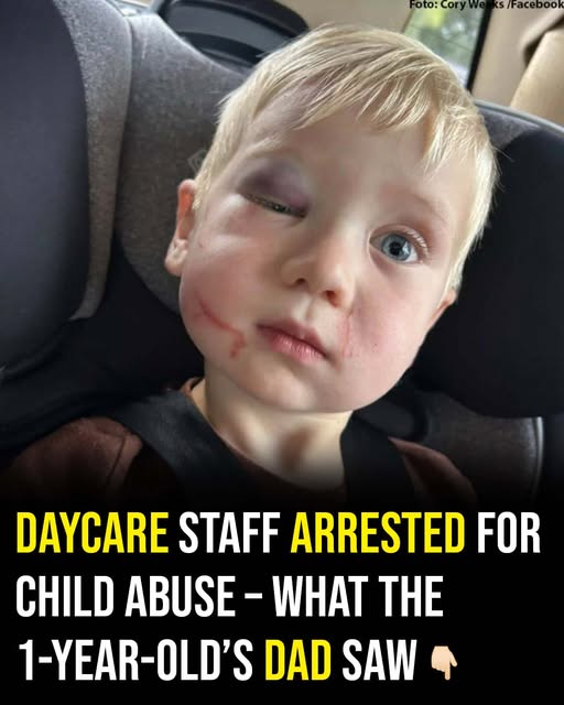 Daycare worker arrested after toddler arrives with black eye and swollen face on first day