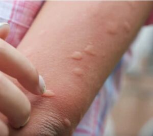 Doctors warn against viral hot spoon mosquito hack