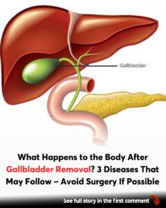 What to Expect After Gallbladder Surgery: Side Effects and Dietary Tips