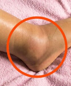 If you notice your legs are swollen, that’s a sign of ca…