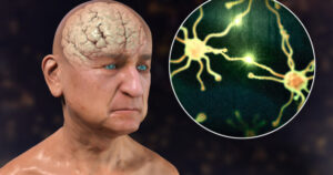 10 signs of dementia you should never ignore – and the habits you should start today