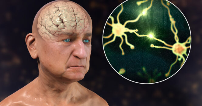 10 signs of dementia you should never ignore – and the habits you should start today