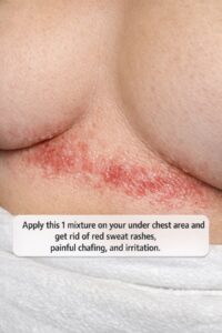 Apply this 1 mixture on your under chest area and get rid of red sweat rashes, painful chafing, and irritation.