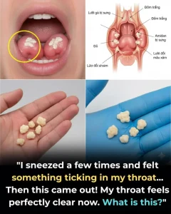 Here’s What You Need to Know About Tonsil Stones (And Why They’re More Common Than You Think)
