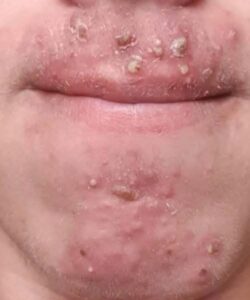 Been dating this woman I met at Walmart and after finally getting some I woke up with these on my face what is this?