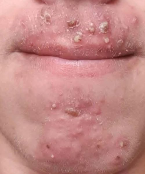 Been dating this woman I met at Walmart and after finally getting some I woke up with these on my face what is this?