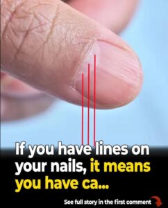 Doctor reveals health issues hidden in your nails