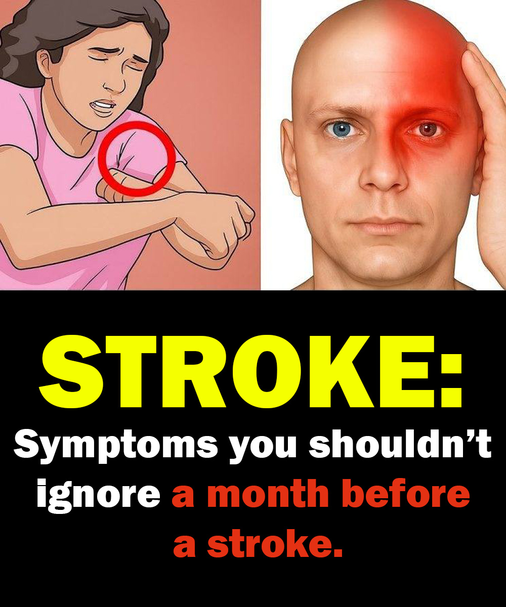 ONE MONTH BEFORE A STROKE, YOUR BODY MAY SEND THESE WA:RNING SIGNS — AND THEY CAN BE DIFFERENT FOR MEN AND WOMEN