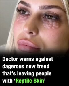 Doctors warn against beauty trend that causes reptile skin