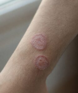 When an Itch Isn’t Just an Itch: James’s Story and the Silent Warning Signs of Skin Conditions