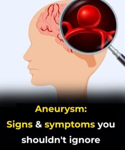 Silent Aneurysms: Why Some Brain Conditions Go Unnoticed