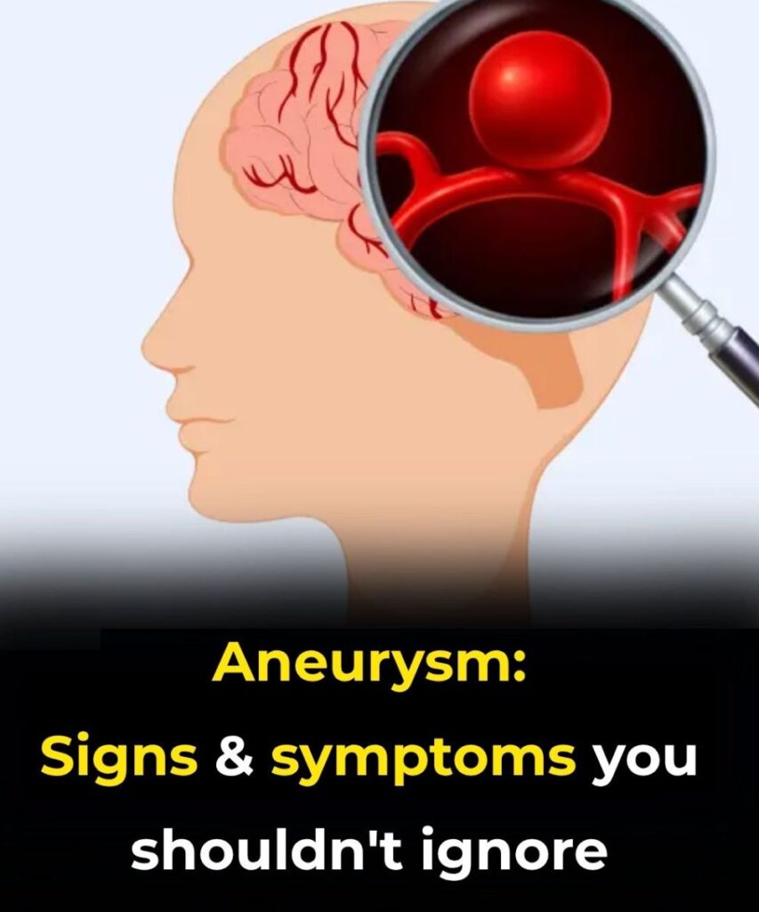 Silent Aneurysms: Why Some Brain Conditions Go Unnoticed