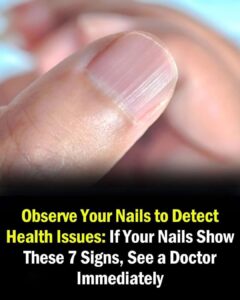 Doctor reveals health issues hidden in your nails