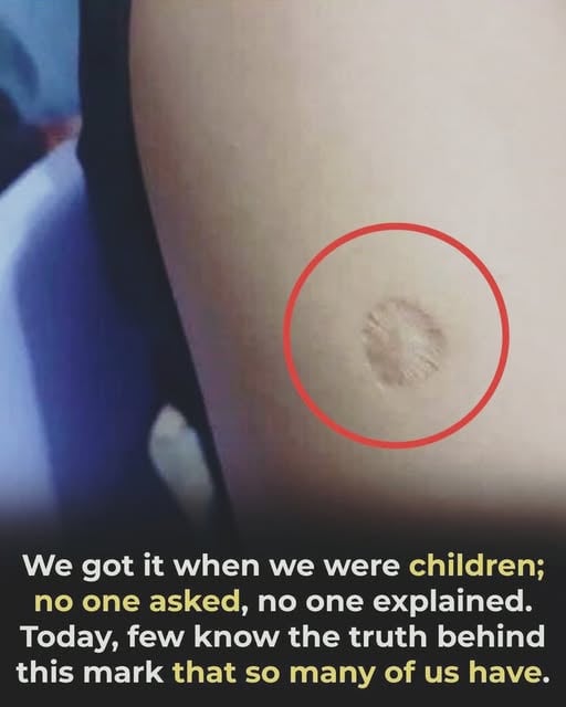 What the small round scar on your arm might indicate That Small Round Scar on Your Upper Arm Might Be Carrying a Piece of History