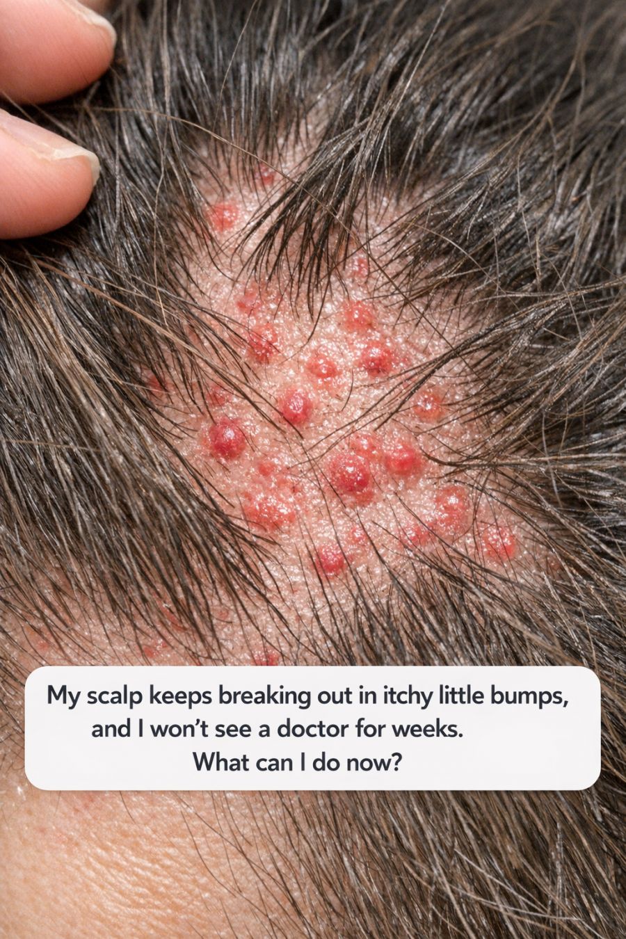 My scalp keeps breaking out in itchy little bumps, and I won’t see a doctor for weeks. What can I do now?