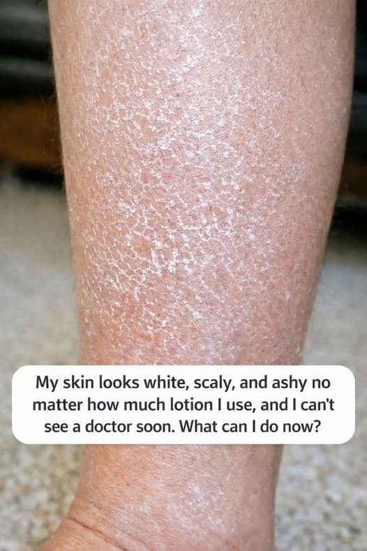 My skin looks white, scaly, and ashy no matter how much lotion I use, and I can’t see a doctor soon. What can I do now?