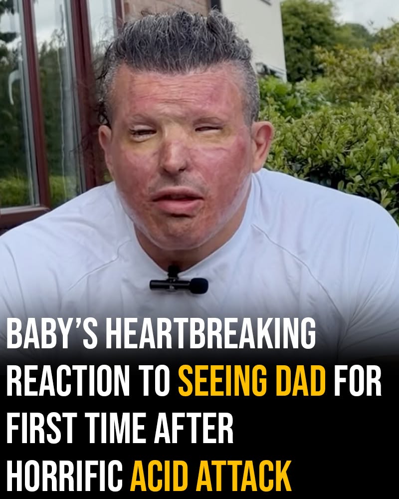 Baby’s heartbreaking reaction to seeing dad for first time after horrific acid attack