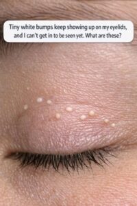 Tiny white bumps keep showing up on my eyelids, and I can’t get in to be seen yet. What are these?