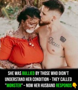 Woman with rare skin condition overcomes negativity and finds true love