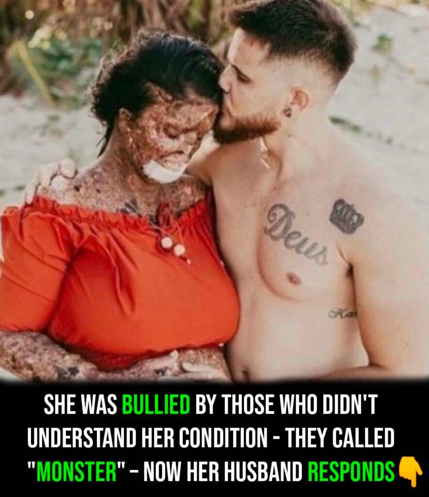 Woman with rare skin condition overcomes negativity and finds true love