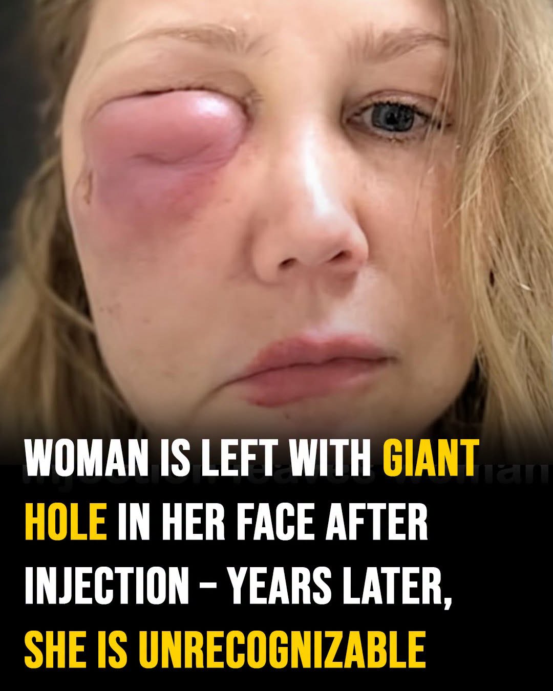 Gina Anderson was left with a big hole in her face after filler failure – this is her today, 6 years later