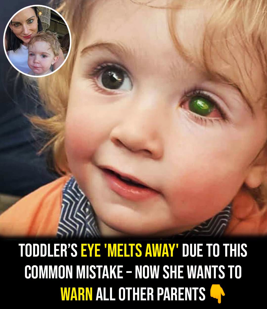 Toddler’s eye ”melts away” after wrong person kissed him