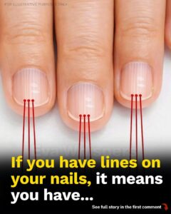 Vertical Lines on Your Nails: What Do They Really Mean for Your Health?