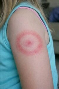 My Daughter Woke Up With a Strange Red Ring on Her Arm: A Parent’s Guide to Ring-Shaped Rashes (And When to Breathe Easy)
