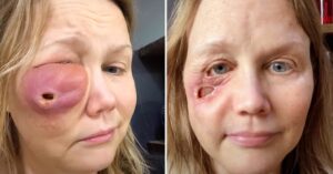 Gina Anderson was left with a big hole in her face after filler failure – this is her today, 6 years later