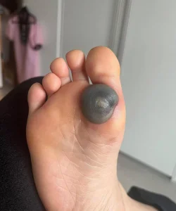 My daughter woke up with this huge spot on her foot I don’t know what it could be. She’s been in pain and can’t move her foot what is this.. Explain this