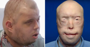 Firefighter suffers third-degree burns – this is him 11 years later