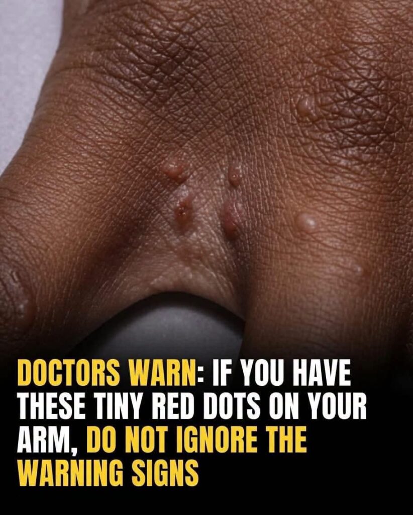If you see these painful red bumps, you may have dyshidrotic eczema
