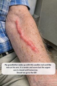 My grandfather woke up with this swollen red cord like vein on his arm. It is tender and warm but the urgent care is closed until tomorrow. Should we go to the ER?