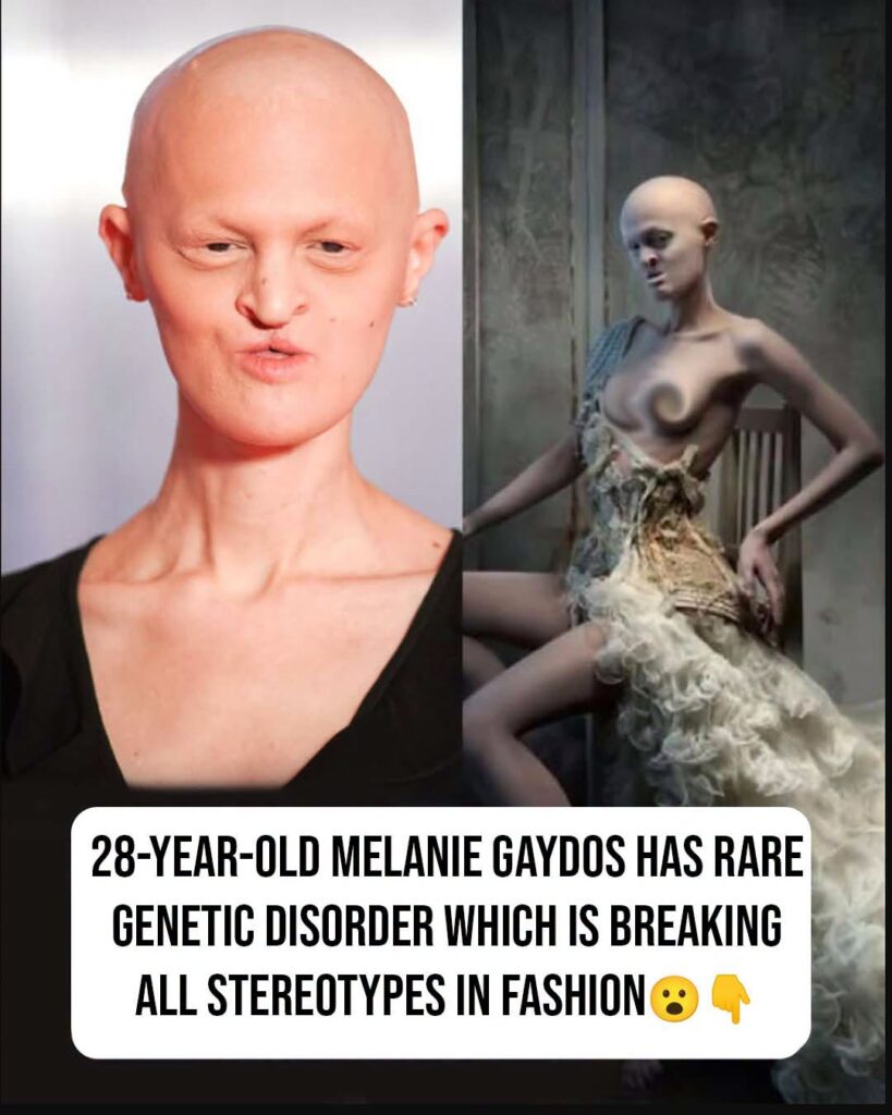 Model born with rare genetic disorder breaks beauty standards