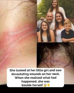 13-year-old girl left with horrific burns on her neck after using her cellphone while it was charging