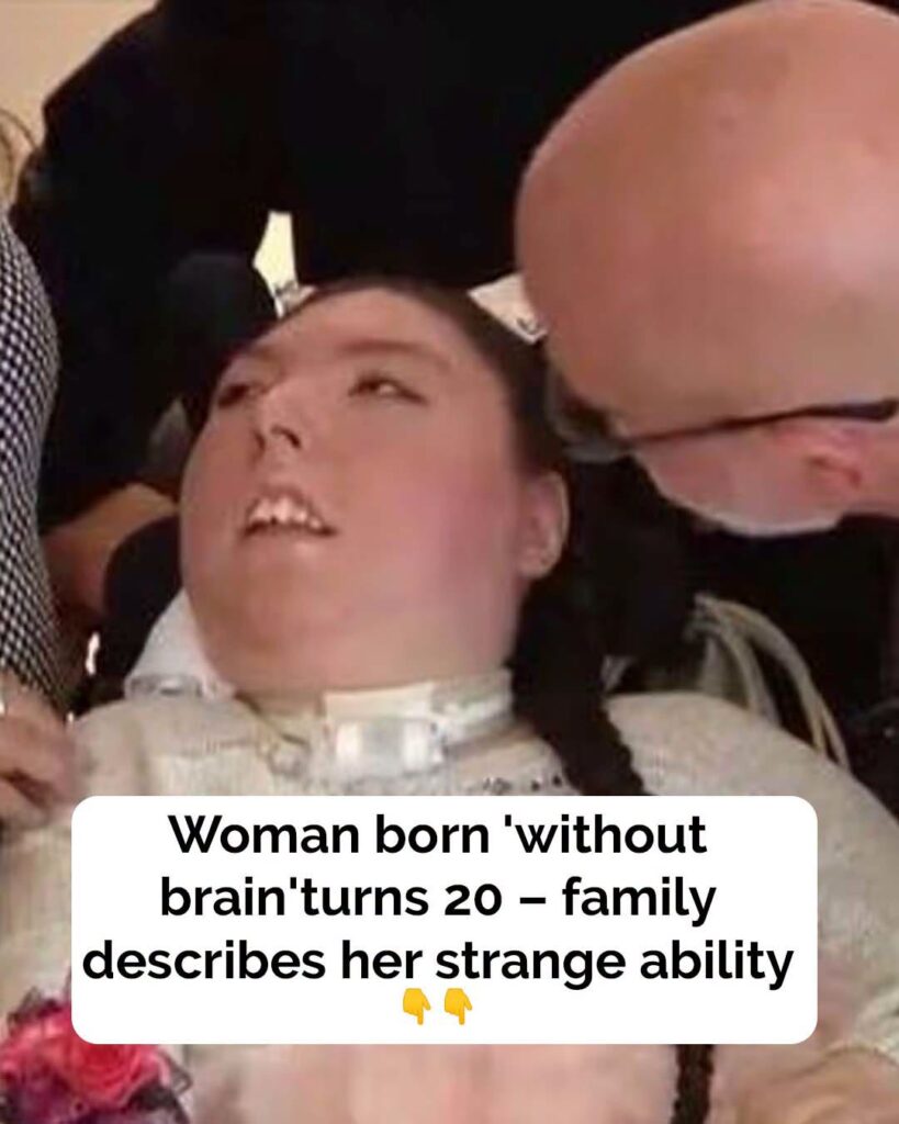 Woman born without brain turns 20, family calls her ‘miracle’