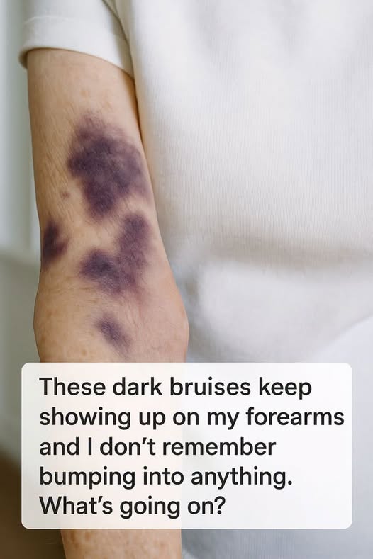 These dark bruises keep showing up on my forearms and I don’t remember bumping into anything. What’s going on?
