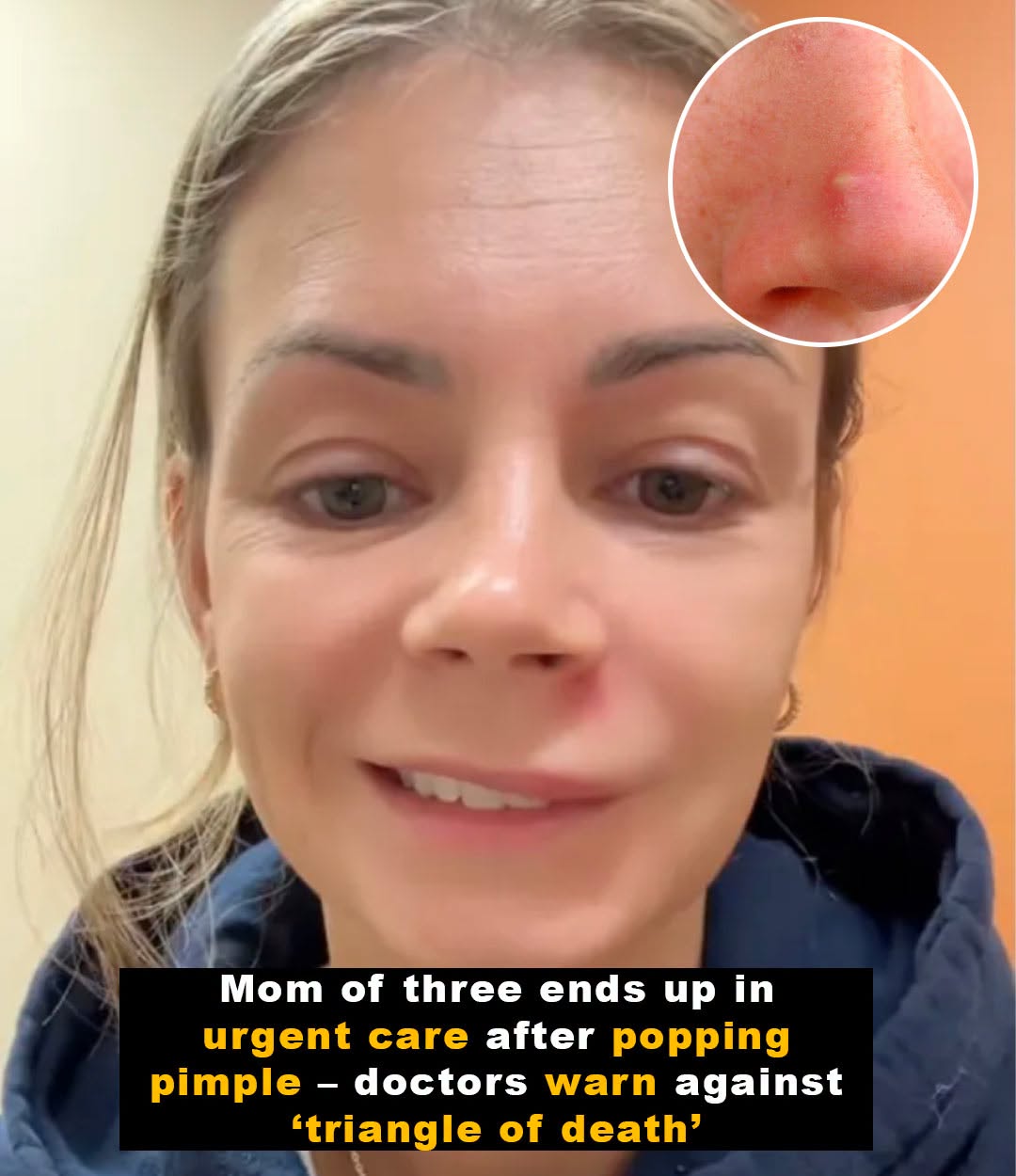 Doctors warn of popping pimple in ‘triangle of death’