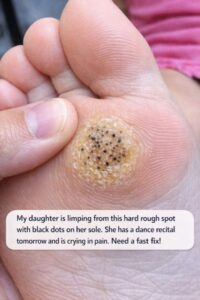 My daughter is limping from this hard rough spot with black dots on her sole. She has a dance recital tomorrow and is crying in pain. Need a fast fix!