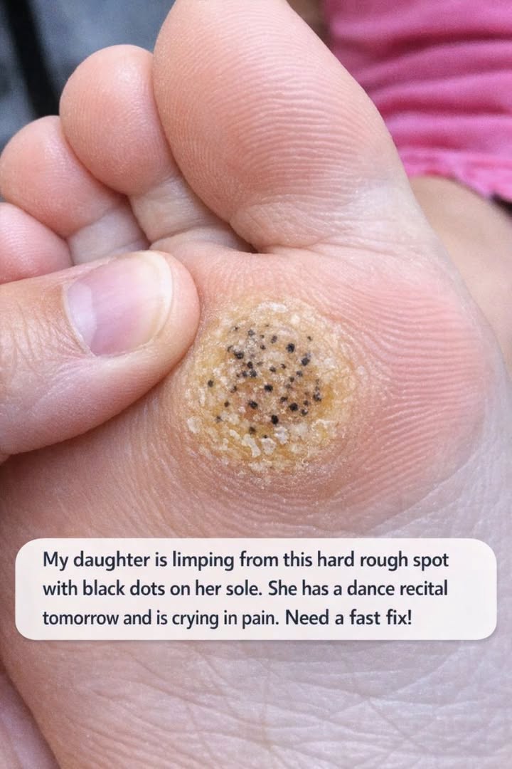 My daughter is limping from this hard rough spot with black dots on her sole. She has a dance recital tomorrow and is crying in pain. Need a fast fix!