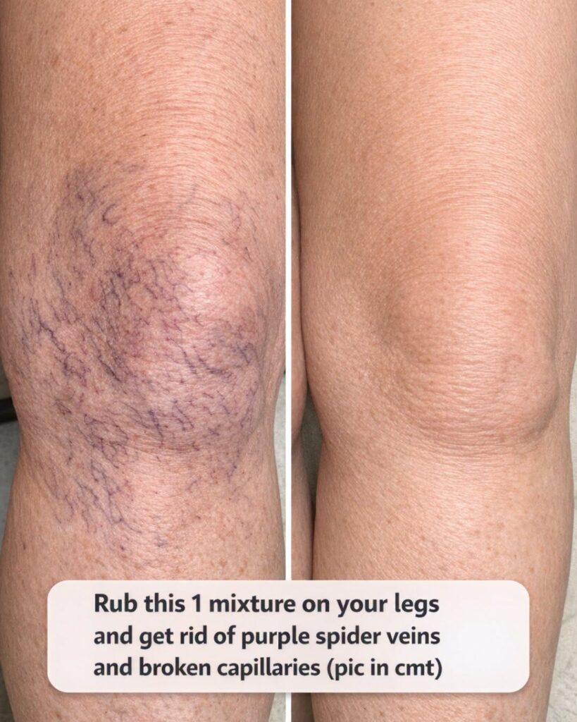Rub this 1 mixture on your legs and get rid of purple spider veins and broken capillaries