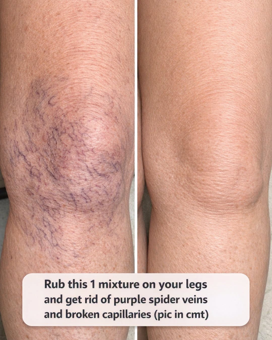 Rub this 1 mixture on your legs and get rid of purple spider veins and broken capillaries