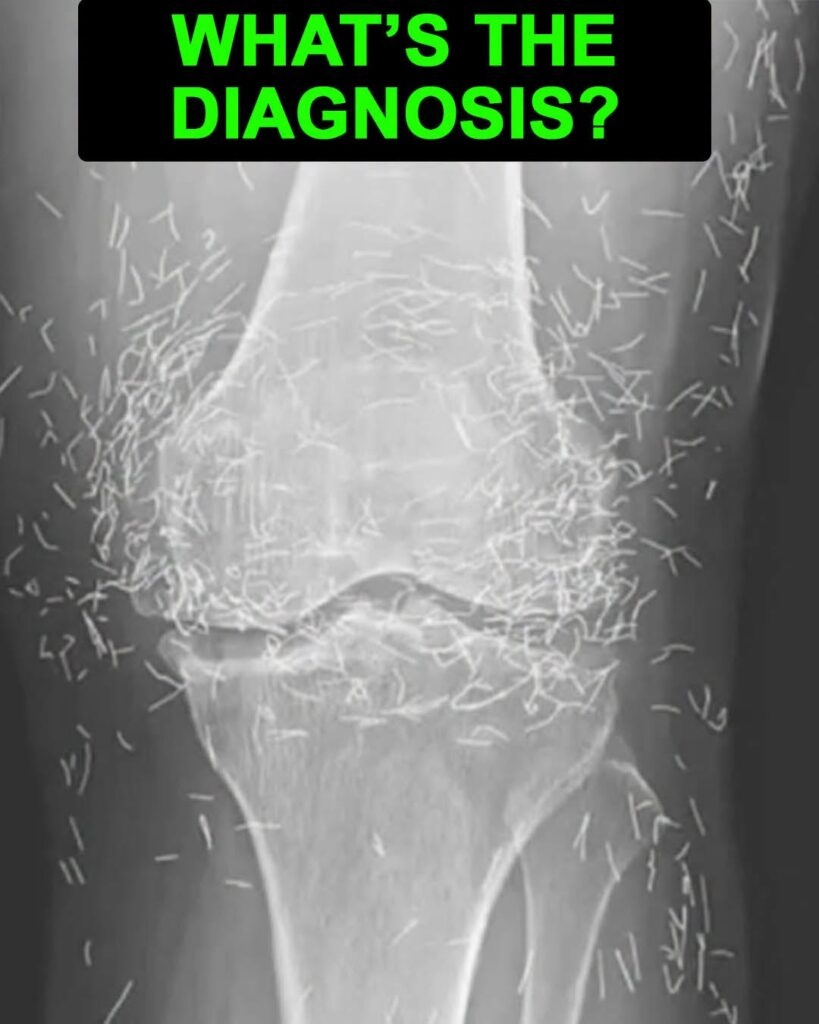 Doctors find “gold mine” in woman’s knees