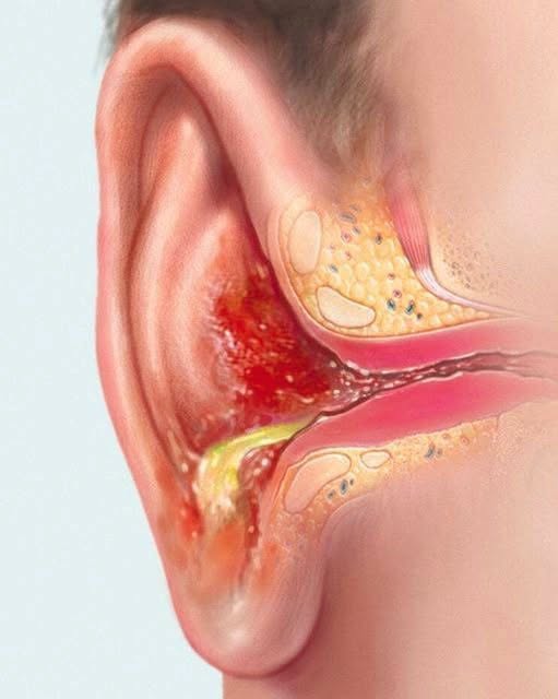 The Best Home Remedies For Getting Rid of Ear Infection