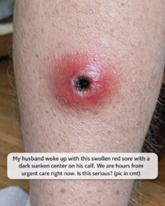 My husband woke up with this swollen red sore with a dark sunken center on his calf. We are hours from urgent care right now. Is this serious?