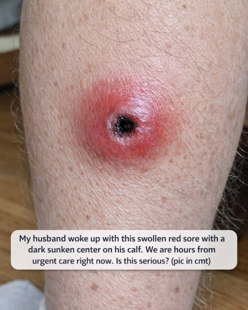 My husband woke up with this swollen red sore with a dark sunken center on his calf. We are hours from urgent care right now. Is this serious?
