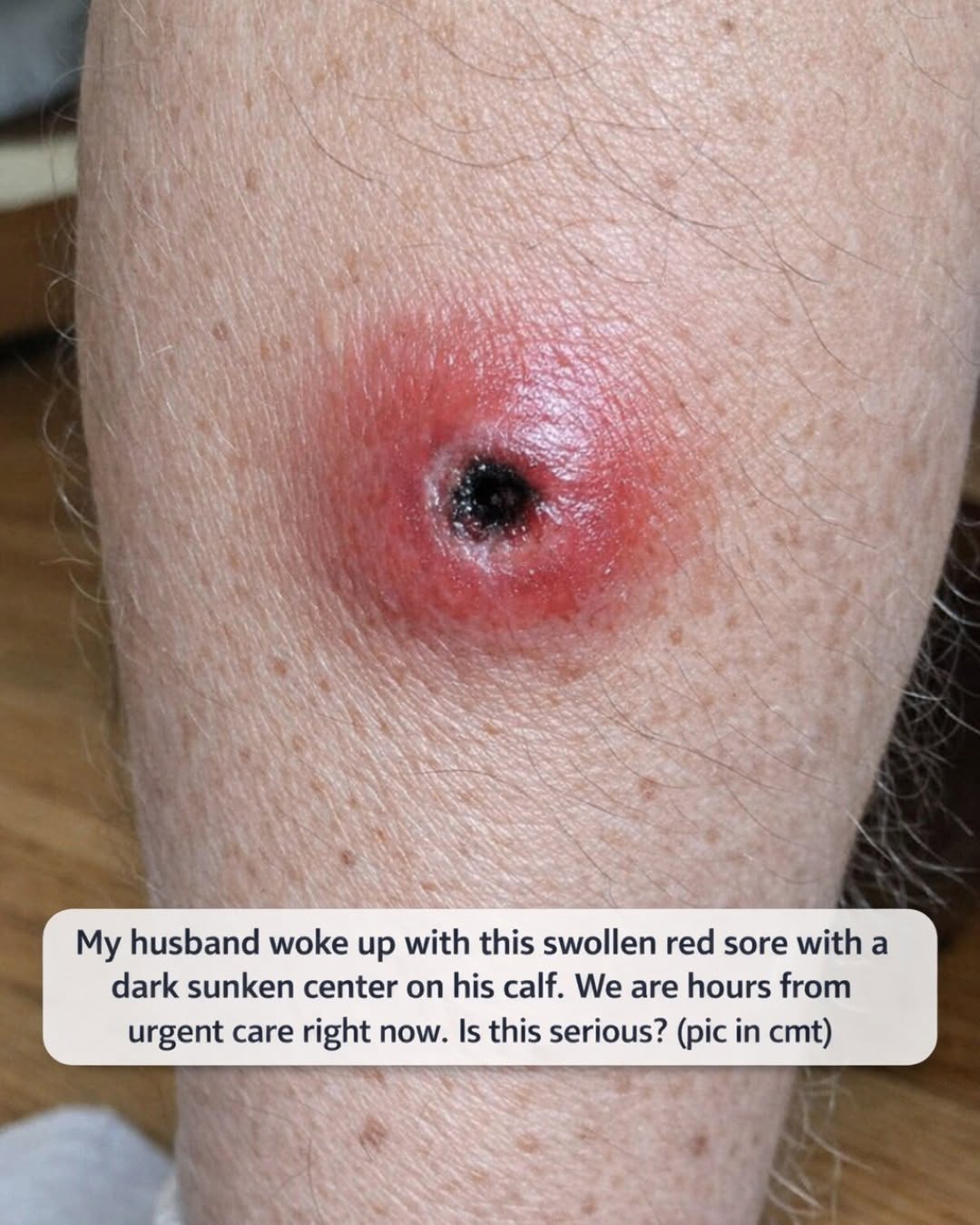 My husband woke up with this swollen red sore with a dark sunken center on his calf. We are hours from urgent care right now. Is this serious?