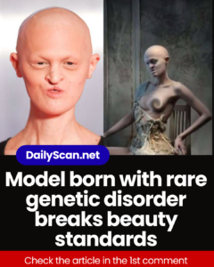 Model born with rare genetic disorder breaks beauty standards